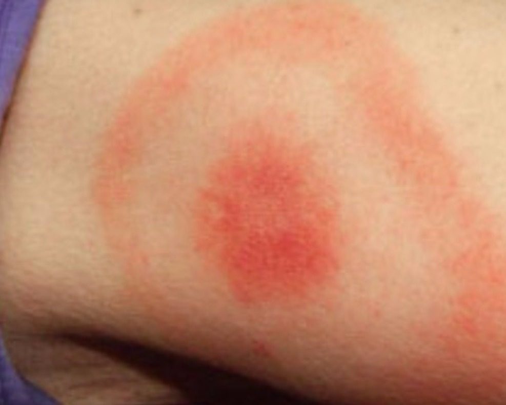 Lyme Disease - Bioresonance Therapeutics